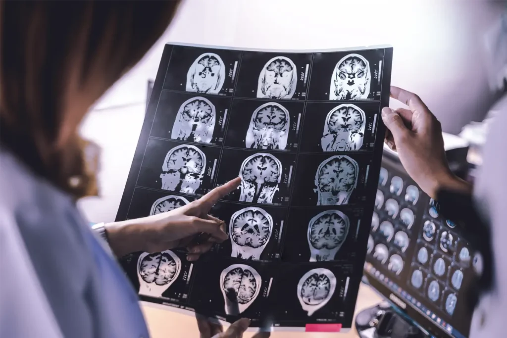 Soplówka jeżowata w leczeniu chorób neurodegeneracyjnych